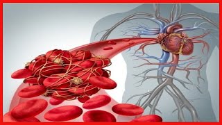 Embolie pulmonaire  symptômes et traitement [upl. by Eintroc]