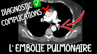 Radiologie  Lembolie pulmonaire pour lEDN  bases pour tout médecin [upl. by Nylram793]