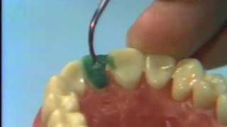 Dental Anatomy Waxing a Maxillary Central Incisor [upl. by Ayojal305]