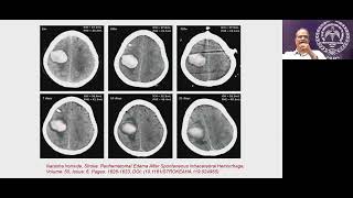 quotManagement of Intracranial HemorrhagequotLecture [upl. by Nairret]