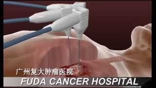 Cancer Cryosurgical Ablation [upl. by Baudoin]