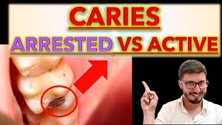 How to Differentiate between Arrested and Active CARIES Clinical Cases caries removal ICDAS [upl. by Chryste]