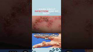 Infection health survival avoid [upl. by Schuler]