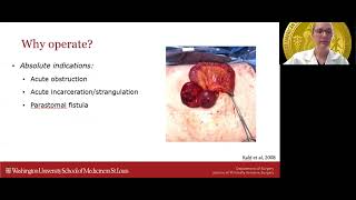 Evaluating a New Parastomal Hernia amp When to Operate [upl. by Ernst]