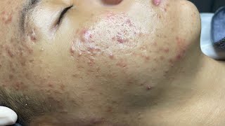 ACNE TREATMENT VU QUYNH MI  Perennial Blackheads On Boy Face 2024FULL [upl. by Mamie]