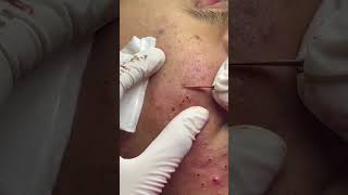 Best Pimple Popping 07 beautiful blackheads sacdepspa [upl. by Gannie927]