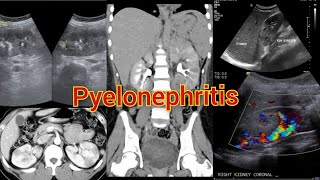 Radiology Viva Case  05  Pyelonephritis Complicated by Pseudoaneurysm medical radiology doppler [upl. by Isidoro]