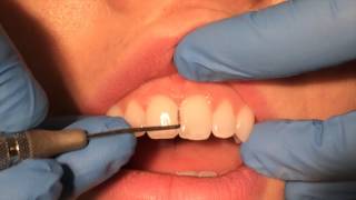 Periodontal Probing [upl. by Aierb]