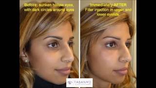 Sunken Eyes Dark Circles Eyelid Filler InjectionBefore and After  877 697–5173 [upl. by Cchaddie]