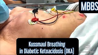 Kussmaul Breathing seen in Diabetic Ketoacidosis DKA mbbs medicine neetpg aiims usmle [upl. by Nwahsear]