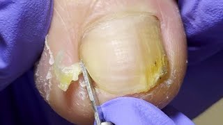 The Complete Onychomycosis Cleanup Process [upl. by Goetz406]