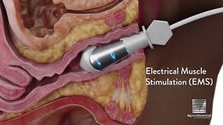 Empower RF by Inmode Modes of Action [upl. by Aggi]