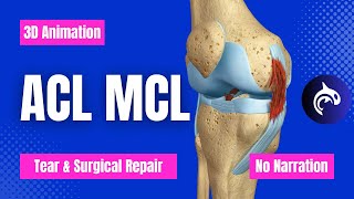 ACL Anterior Cruciate Ligament MCL Medial Collateral Ligament Tear and Repair No Narration [upl. by Schwartz]