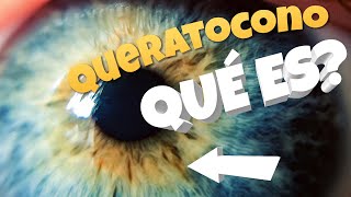 🔥 ¿Qué es el QUERATOCONO y como se TRATA [upl. by Lenahtan]