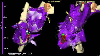 AV node reentry tachycardia atrial activation with 3D mapping [upl. by Kciv]