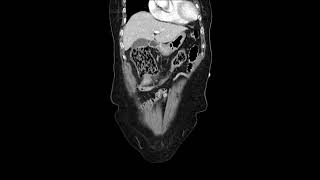 transverse colon cancer [upl. by Stier]