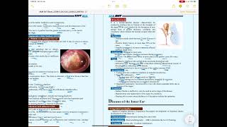 Otosclerosis [upl. by Burnaby]