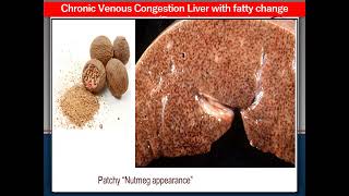 Bilharziasis UB Chronic venous congestion liver fatty change  Chronic rheumatic valvulitis [upl. by Ahcila]