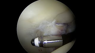 Articular Cartilage with a Grade 3 Injury to the Posterior Acetabulum near full thickness [upl. by Oeflein632]