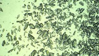 Struvite crystals in urine [upl. by Petunia]