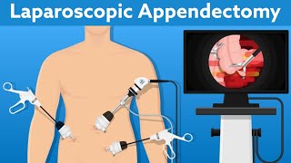 Laparoscopic  Appendix Removal Surgery  Appendectomy Instruments  Complications of Appendectomy [upl. by Leina707]