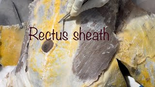 Rectus Sheath  dissection Dr Geetanjali Karle [upl. by Tnarg580]