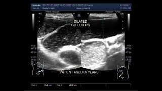 Ultrasound Video showing intestinal obstruction with dilated gut loops [upl. by Rabbi]