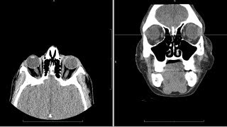 CT computed tomography face radiology search pattern [upl. by Novello]