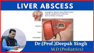 liver abscess  Hepatic abscess  Amoebic abscess  Deepak PD Singh [upl. by Raymond]