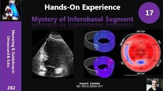 Handson Experience 17 Mystery of Inferobasal Segment [upl. by Nibroc]