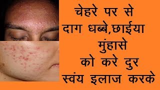 Pimples  Homeopathic treatment for ACNE [upl. by Nudnarb877]