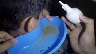 Hard amp Massive Earwax Removal by Ear Irrigation [upl. by Betti]