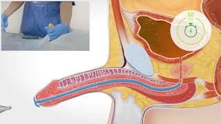 Cathétérisme avec sonde à demeure Homme [upl. by Panter]