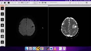 How to report MR spectroscopy [upl. by Sadira]