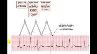 EKG EXTRASYSTOLES [upl. by Flori]