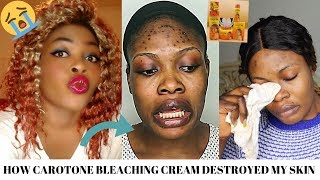 STORYTIME HOW CAROTONE BLEACHING CREAM DESTROYED MY SKIN😭😭 [upl. by Mckale]