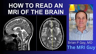 How to read an MRI of the brain  First Look MRI [upl. by Ahen992]