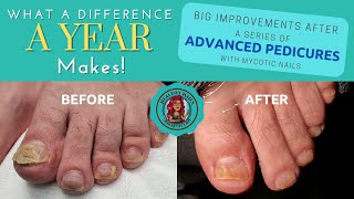 What a Difference a Year Makes Advanced Pedicure for Mycotic Nails [upl. by Radmen]