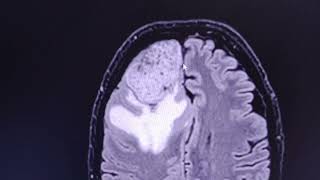 Aggressive meningioma  CT venogram and MRI [upl. by Sorensen754]