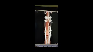 شرح فحص الاشعه المقطعيه بالصبغه علي اوردة الطرف السفلي \ CT Lower limb venography [upl. by Virgie]