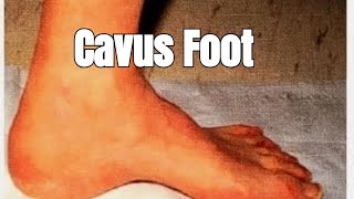 Why NonNeuromuscular Cavus Foot is NOT What You Think 2024 [upl. by Tania]