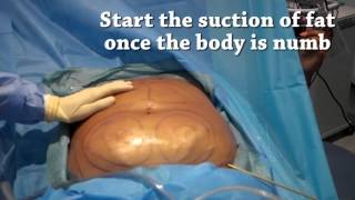 How is liposuction performed  Tutorial  Centre for Surgery [upl. by Sevy967]