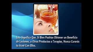 Remedios Caseros Para el Acne Como Eliminar Acne Rapido [upl. by Enyawad666]