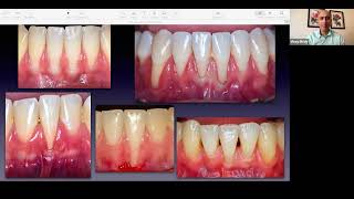 Unlocking the Mysteries of the Anterior Mandible for Optimizing Root Coverage Outcomes [upl. by Ytak212]