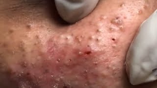 How to remove blackheads and whiteheads at homeHow to remove acne30 [upl. by Maghutte]