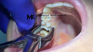 extraction of upper first molar using forceps [upl. by Trotta547]