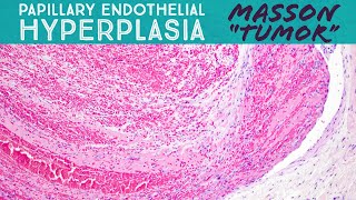 Masson quotTumorquot organizing thrombus amp papillary endothelial hyperplasia in a vascular malformation [upl. by Eeuqram743]