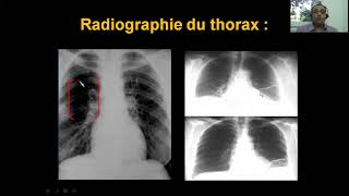 Embolie pulmonaire Dr Khacha Cardio  Quatrième Année Médecine [upl. by Koser137]