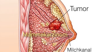 Mammakarzinom  Brustkrebs Ursache Symptome Risikofaktoren und Therapie [upl. by Ayekal595]