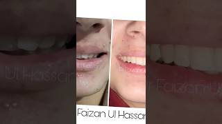 Ceramic braces minimal Treatment big change viralbraces orthodontist smile shorts [upl. by Naesar]